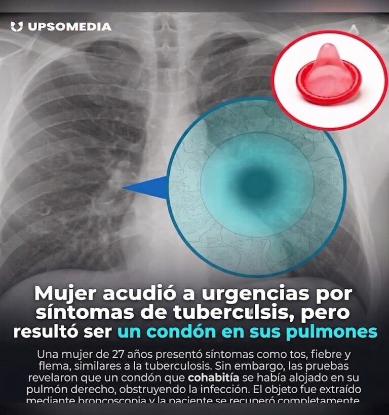 El Insólito Caso Médico: Fue a Urgencias por Tuberculosis y el Diagnóstico Dejó Atónitos a Todos